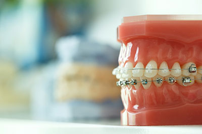 What Can a Downey Orthodontist Do About an Adult Underbite?
